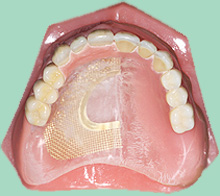 Teilprothesen Zahnarzt