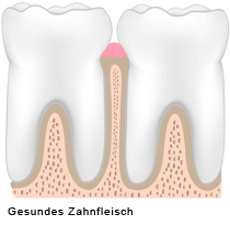 parodontitis.gif